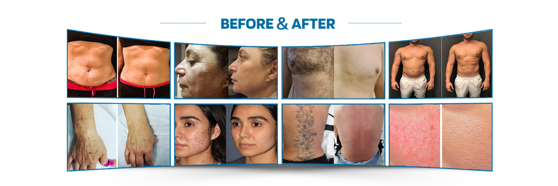 Qualität Laser-Haar-Abbau-Maschine usine