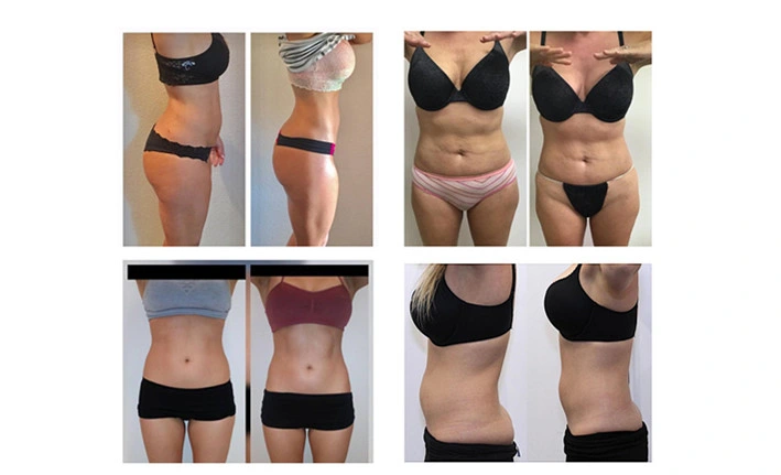 Erweiterte Lipolaser-Lipolyse 209mw Super 6d Lipo Laser Liposuktionsmaschine mit 635nm 650nm 780nm 810nm 940nm 980nm 6