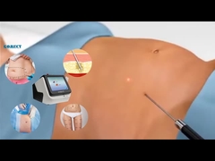 Laser Lipo Ausrüstung 30W 60W 980nm Diode Lipo Laser Maschine für Gewichtsverlust