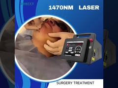 Endolaser 1470 Lifting Gesichtslipolyse Endovenale Laser Spinnenvenenentfernung
